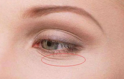 女人臉上陰騭紋真實(shí)照片 女人臉上陰騭紋是好是壞