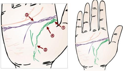 感情線呈鎖鏈狀代表什么