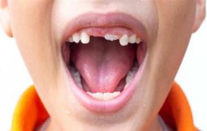 夢見牙齒掉一半留一半是什么意思