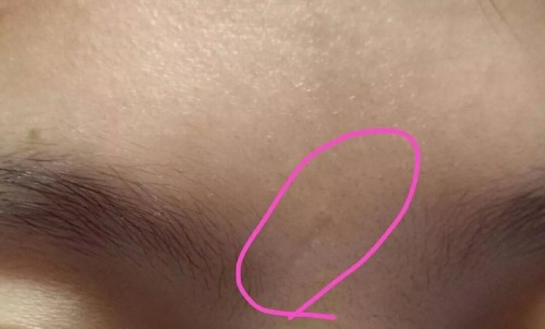 印堂有疤痕的男人命運(yùn)