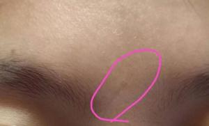 印堂有疤痕的男人命運